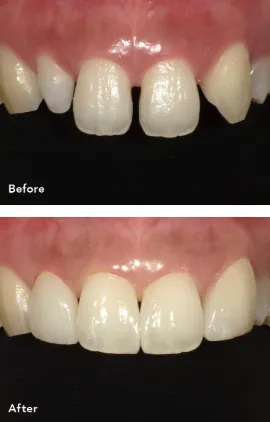 コンポジットレジンの修復例