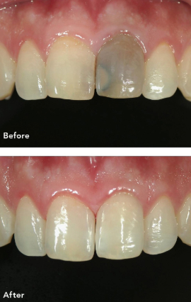 変色した前歯への対応