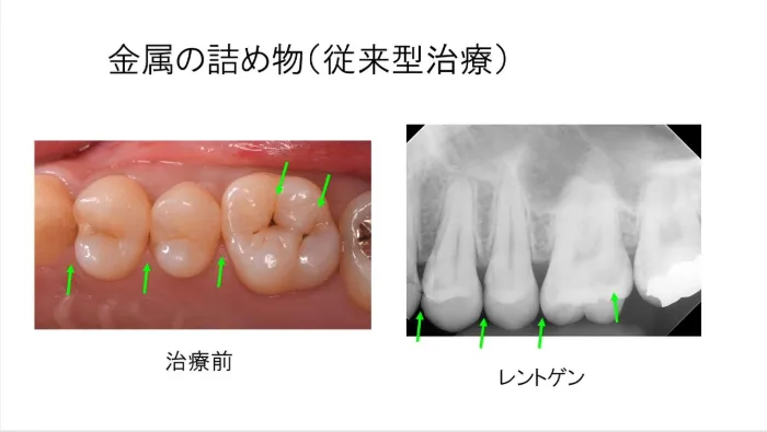 金属の詰め物(従来型保険治療)