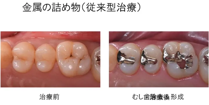 金属の詰め物(従来型治療)