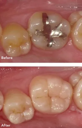 コンポジットレジンの修復例