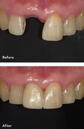 前歯欠損への対応