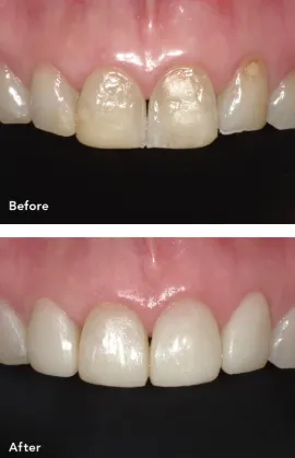 コンポジットレジンの修復例