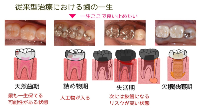 従来型治療における歯の一生 (1)