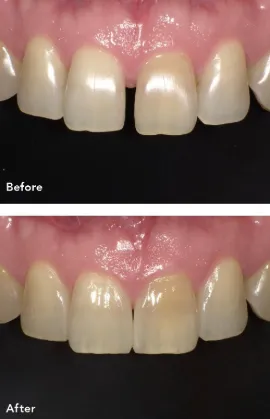 コンポジットレジンの修復例