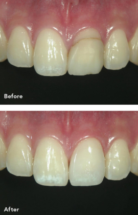 前歯の審美性改善