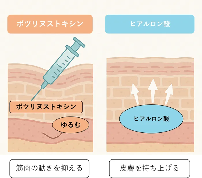 ボツリヌストキシン治療とヒアルロン酸注入の違い