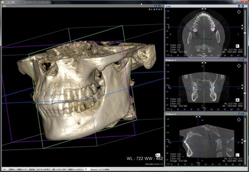 CTによる骨量の確認とシミュレーション